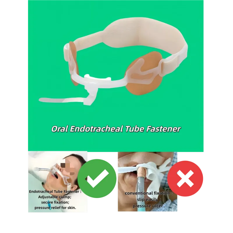 Endotracheale tubebevestiging